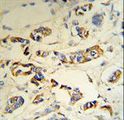 Complement C1QA Antibody - C1QA Antibody (RB18692) IHC of formalin-fixed and paraffin-embedded human breast carcinoma tissue followed by peroxidase-conjugated secondary antibody and DAB staining.