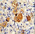 Complement C5 Antibody - Formalin-fixed and paraffin-embedded human breast carcinoma with C5 Antibody , which was peroxidase-conjugated to the secondary antibody, followed by DAB staining. This data demonstrates the use of this antibody for immunohistochemistry; clinical relevance has not been evaluated.
