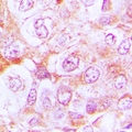 Complement C6 Antibody - Immunohistochemical analysis of Complement C6 staining in human lung cancer formalin fixed paraffin embedded tissue section. The section was pre-treated using heat mediated antigen retrieval with sodium citrate buffer (pH 6.0). The section was then incubated with the antibody at room temperature and detected using an HRP conjugated compact polymer system. DAB was used as the chromogen. The section was then counterstained with hematoxylin and mounted with DPX.