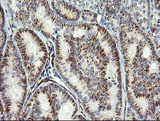 COPS6 / CSN6 Antibody - IHC of paraffin-embedded Carcinoma of Human thyroid tissue using anti-COPS6 mouse monoclonal antibody.