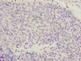 COPZ1 Antibody - Immunohistochemistry of paraffin-embedded human cervical cancer using antibody at dilution of 1:100.
