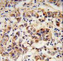 CORNIFIN / SPRR1B Antibody - Formalin-fixed and paraffin-embedded human breast carcinoma reacted with SPRR1B Antibody , which was peroxidase-conjugated to the secondary antibody, followed by DAB staining. This data demonstrates the use of this antibody for immunohistochemistry; clinical relevance has not been evaluated.