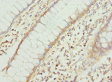 COX10 Antibody - Immunohistochemistry of paraffin-embedded human rectal cancer at dilution 1:100