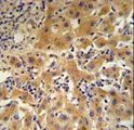 CP / Ceruloplasmin Antibody - CP Antibody IHC of formalin-fixed and paraffin-embedded human hepatocarcinoma followed by peroxidase-conjugated secondary antibody and DAB staining.