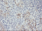 CPA1 / Carboxypeptidase A Antibody - IHC of paraffin-embedded Carcinoma of Human bladder tissue using anti-CPA1 mouse monoclonal antibody.