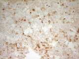 CPB2 / TAFI Antibody - IHC of paraffin-embedded Carcinoma of Human lung tissue using anti-CPB2 mouse monoclonal antibody. (Heat-induced epitope retrieval by 1 mM EDTA in 10mM Tris, pH8.5, 120°C for 3min).