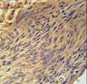 CPEB4 Antibody - CPEB4 Antibody immunohistochemistry of formalin-fixed and paraffin-embedded human lung carcinoma followed by peroxidase-conjugated secondary antibody and DAB staining.