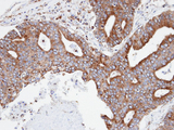 CPNE3 Antibody - IHC of paraffin-embedded endo mitral OVCA using CPNE3 antibody at 1:100 dilution.