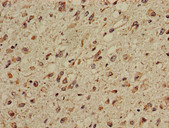 CPT1C Antibody - Immunohistochemistry of paraffin-embedded human glioma cancer using CPT1C Antibody at dilution of 1:100
