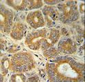 CRABP1 / CRABP Antibody - CRABP1 Antibody immunohistochemistry of formalin-fixed and paraffin-embedded human prostate carcinoma followed by peroxidase-conjugated secondary antibody and DAB staining.
