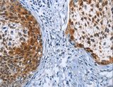 CRABP2 Antibody - Immunohistochemistry of paraffin-embedded Human cervical cancer using CRABP2 Polyclonal Antibody at dilution of 1:40.