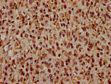 CRB2 Antibody - IHC image of CRB2 Antibody diluted at 1:1600 and staining in paraffin-embedded human glioma performed on a Leica BondTM system. After dewaxing and hydration, antigen retrieval was mediated by high pressure in a citrate buffer (pH 6.0). Section was blocked with 10% normal goat serum 30min at RT. Then primary antibody (1% BSA) was incubated at 4°C overnight. The primary is detected by a biotinylated secondary antibody and visualized using an HRP conjugated SP system.