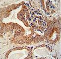 CRD-BP / ZBP1 / IGF2BP1 Antibody - IGF2BP1 antibody immunohistochemistry of formalin-fixed and paraffin-embedded human prostate carcinoma followed by peroxidase-conjugated secondary antibody and DAB staining.