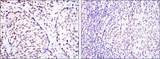 CREB1 / CREB Antibody - IHC of paraffin-embedded prostate cancer tissues (left) and submaxillary tumor tissues (right) using CREB1 mouse monoclonal antibody with DAB staining.