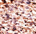 CREB1 / CREB Antibody - Formalin-fixed and paraffin-embedded human cancer tissue reacted with the primary antibody, which was peroxidase-conjugated to the secondary antibody, followed by AEC staining. This data demonstrates the use of this antibody for immunohistochemistry; clinical relevance has not been evaluated. BC = breast carcinoma; HC = hepatocarcinoma.