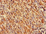 CRIPT Antibody - Immunohistochemistry of paraffin-embedded human liver cancer using CRIPT Antibody at dilution of 1:100