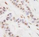 CRTC3 Antibody - Detection of Human TORC3 by Immunohistochemistry. Sample: FFPE section of human breast carcinoma. Antibody: Affinity purified rabbit anti-TORC3 used at a dilution of 1:200 (1 ug/ml). Detection: DAB.