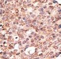 CRY2 Antibody - Formalin-fixed and paraffin-embedded human cancer tissue reacted with the primary antibody, which was peroxidase-conjugated to the secondary antibody, followed by DAB staining. This data demonstrates the use of this antibody for immunohistochemistry; clinical relevance has not been evaluated. BC = breast carcinoma; HC = hepatocarcinoma.