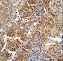 CSA / ERCC8 Antibody - ERCC8 antibody immunohistochemistry of formalin-fixed and paraffin-embedded human lung carcinoma followed by peroxidase-conjugated secondary antibody and DAB staining.
