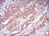 CSF1R / CD115 / FMS Antibody - IHC of paraffin-embedded cervical cancer tissues using CSF1R mouse monoclonal antibody with DAB staining.