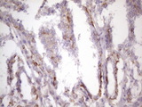 CSF2 / GM-CSF Antibody - IHC of paraffin-embedded Carcinoma of Human thyroid tissue using anti-CSF2 mouse monoclonal antibody. (Heat-induced epitope retrieval by 1 mM EDTA in 10mM Tris, pH8.5, 120°C for 3min)(1:150).