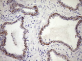 CSF2RB / CD131 Antibody - IHC of paraffin-embedded Carcinoma of Human prostate tissue using anti-CSF2RB mouse monoclonal antibody. (Heat-induced epitope retrieval by Tris-EDTA, pH8.0)(1:150).