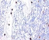 CSF3 / G-CSF Antibody - Formalin-fixed, paraffin-embedded human tonsil stained with G-CSF antibody (CSF3/900). Note specific cytoplasmic staining of granulocytes.  This image was taken for the unmodified form of this product. Other forms have not been tested.
