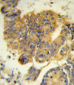 CSF3R / CD114 Antibody - Formalin-fixed and paraffin-embedded human colon carcinoma reacted with CSF3R Antibody , which was peroxidase-conjugated to the secondary antibody, followed by DAB staining. This data demonstrates the use of this antibody for immunohistochemistry; clinical relevance has not been evaluated.