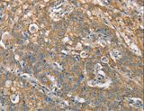CSMD1 Antibody - Immunohistochemistry of paraffin-embedded Human gastric cancer using CSMD1 Polyclonal Antibody at dilution of 1:40.