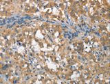 CSMD1 Antibody - Immunohistochemistry of paraffin-embedded Human thyroid cancer using CSMD1 Polyclonal Antibody at dilution of 1:40.