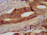 CSN2 / Beta Casein Antibody - Immunohistochemistry image at a dilution of 1:300 and staining in paraffin-embedded human colon cancer performed on a Leica BondTM system. After dewaxing and hydration, antigen retrieval was mediated by high pressure in a citrate buffer (pH 6.0) . Section was blocked with 10% normal goat serum 30min at RT. Then primary antibody (1% BSA) was incubated at 4 °C overnight. The primary is detected by a biotinylated secondary antibody and visualized using an HRP conjugated SP system.