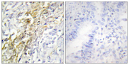 CSNK1A1 / CK1 Alpha Antibody - Immunohistochemistry analysis of paraffin-embedded human lung carcinoma tissue, using CKI-alpha Antibody. The picture on the right is blocked with the synthesized peptide.