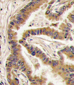 CSNK1A1 / CK1 Alpha Antibody - Formalin-fixed and paraffin-embedded human lung carcinoma tissue reacted with CK1a antibody , which was peroxidase-conjugated to the secondary antibody, followed by DAB staining. This data demonstrates the use of this antibody for immunohistochemistry; clinical relevance has not been evaluated.
