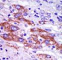 CSNK1D Antibody - Formalin-fixed and paraffin-embedded human cancer tissue reacted with the primary antibody, which was peroxidase-conjugated to the secondary antibody, followed by DAB staining. This data demonstrates the use of this antibody for immunohistochemistry; clinical relevance has not been evaluated. BC = breast carcinoma; HC = hepatocarcinoma.