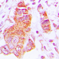 CSNK1E / CK1 Epsilon Antibody - Immunohistochemical analysis of CK1 epsilon staining in human lung cancer formalin fixed paraffin embedded tissue section. The section was pre-treated using heat mediated antigen retrieval with sodium citrate buffer (pH 6.0). The section was then incubated with the antibody at room temperature and detected using an HRP conjugated compact polymer system. DAB was used as the chromogen. The section was then counterstained with hematoxylin and mounted with DPX.