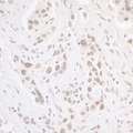 CSNK2A1 Antibody - Detection of human CKII Alpha by immunohistochemistry. Sample: FFPE section of human ovarian carcinoma. Antibody: Affinity purified rabbit anti-CKII Alpha used at a dilution of 1:1,000 (1µg/ml). Detection: DAB