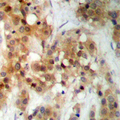 CSNK2A1 Antibody - Immunohistochemical analysis of CK2 alpha staining in human breast cancer formalin fixed paraffin embedded tissue section. The section was pre-treated using heat mediated antigen retrieval with sodium citrate buffer (pH 6.0). The section was then incubated with the antibody at room temperature and detected using an HRP conjugated compact polymer system. DAB was used as the chromogen. The section was then counterstained with hematoxylin and mounted with DPX.