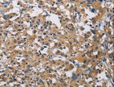 CST4 / Cystatin S Antibody - Immunohistochemistry of paraffin-embedded Human thyroid cancer using CST4 Polyclonal Antibody at dilution of 1:60.