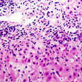 CST6 / Cystatin E/M Antibody - Immunohistochemical analysis of Cystatin E/M staining in human liver cancer formalin fixed paraffin embedded tissue section. The section was pre-treated using heat mediated antigen retrieval with sodium citrate buffer (pH 6.0). The section was then incubated with the antibody at room temperature and detected using an HRP conjugated compact polymer system. DAB was used as the chromogen. The section was then counterstained with hematoxylin and mounted with DPX.
