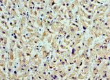 CST7 / Cystatin F Antibody - Immunohistochemistry of paraffin-embedded human liver cancer using antibody at 1:100 dilution.