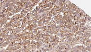 CST7 / Cystatin F Antibody - 1:100 staining human Melanoma tissue by IHC-P. The sample was formaldehyde fixed and a heat mediated antigen retrieval step in citrate buffer was performed. The sample was then blocked and incubated with the antibody for 1.5 hours at 22°C. An HRP conjugated goat anti-rabbit antibody was used as the secondary.