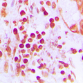 CSTF1 Antibody - Immunohistochemical analysis of CstF-50 staining in human prostate cancer formalin fixed paraffin embedded tissue section. The section was pre-treated using heat mediated antigen retrieval with sodium citrate buffer (pH 6.0). The section was then incubated with the antibody at room temperature and detected using an HRP conjugated compact polymer system. DAB was used as the chromogen. The section was then counterstained with hematoxylin and mounted with DPX.