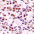 CSTF2 / CstF-64 Antibody - Immunohistochemical analysis of CstF-64 staining in human breast cancer formalin fixed paraffin embedded tissue section. The section was pre-treated using heat mediated antigen retrieval with sodium citrate buffer (pH 6.0). The section was then incubated with the antibody at room temperature and detected using an HRP conjugated compact polymer system. DAB was used as the chromogen. The section was then counterstained with hematoxylin and mounted with DPX.