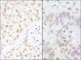 CSTF3 Antibody - Detection of Human and Mouse CSTF77 by Immunohistochemistry. Sample: FFPE section of human breast carcinoma (left) and mouse teratoma (right). Antibody: Affinity purified rabbit anti-CSTF77 used at a dilution of 1:200 (1 ug/ml). Detection: DAB.