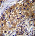 CTAGE5 Antibody - CTAGE5 Antibody immunohistochemistry of formalin-fixed and paraffin-embedded human breast carcinoma followed by peroxidase-conjugated secondary antibody and DAB staining.