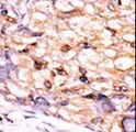 CTDSP1 / SCP1 Antibody - Formalin-fixed and paraffin-embedded human cancer tissue reacted with the primary antibody, which was peroxidase-conjugated to the secondary antibody, followed by DAB staining. This data demonstrates the use of this antibody for immunohistochemistry; clinical relevance has not been evaluated. BC = breast carcinoma; HC = hepatocarcinoma.