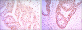 CTG-B45d / THAP11 Antibody - IHC of paraffin-embedded colon cancer tissues (left) and ovary cancer tissues (right) using THAP11 mouse monoclonal antibody with DAB staining.