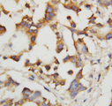 CTH / Cystathionase Antibody - CTH antibody. IHC(P): Human Liver Cancer Tissue.