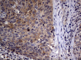 CTNND1 / p120 Catenin Antibody - IHC of paraffin-embedded Carcinoma of Human lung tissue using anti-CTNND1 mouse monoclonal antibody. (Heat-induced epitope retrieval by 10mM citric buffer, pH6.0, 120°C for 3min).