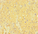 CTNND2 / Delta-2 Catenin Antibody - Immunohistochemistry of paraffin-embedded human glioma cancer at dilution of 1:100